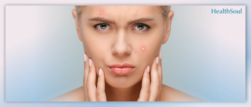 6 Easy Ways to Treat Acne and Get Long-Lasting Results – Healthsoul