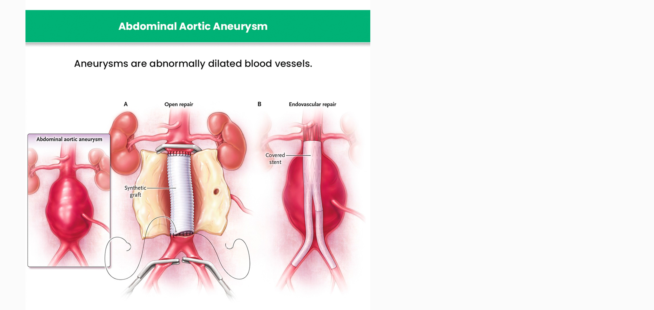 Abdominal Aortic Aneurysm Surgery: Indications and Risks – Healthsoul